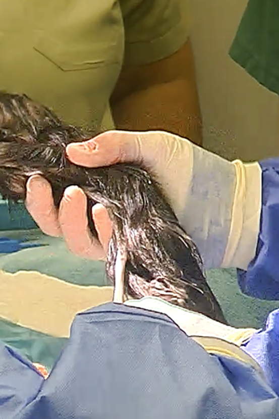 Infant porcupette being removed from mother via C-section
